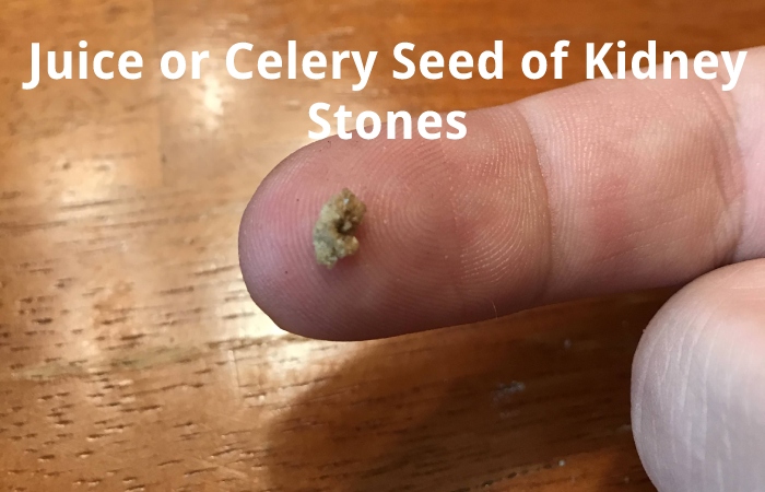 Juice or Celery Seed of Kidney Stones