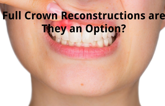 Full Crown Reconstructions are They an Option?